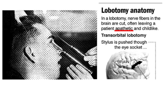 lobotomia tecnica e presupposti